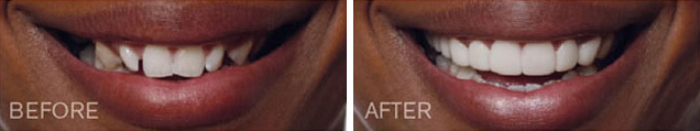 Before and after Snap on Smile in La Jolla with Dr. Han