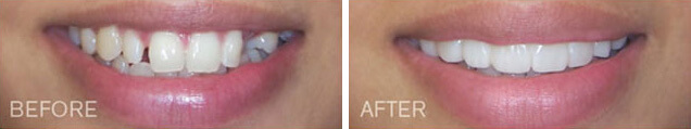 Before and after Snap on Smile in La Jolla with Dr. Briscoe