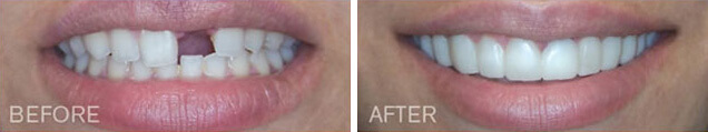 Before and after Snap on Smile in La Jolla with Dr. Han