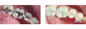 Before and after CEREC crowns performed by Dr. Han in La Jolla