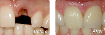 Before and after dental implants in La Jolla with Dr. Briscoe