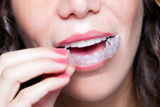 Woman putting Invisalign on top teeth