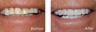 Before and after photos of porcelain veneers in La Jolla by Dr. Briscoe