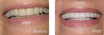 Before and after photos of porcelain veneers in La Jolla by Dr. Briscoe