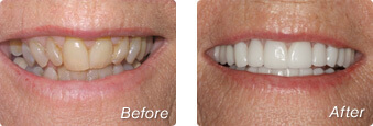 Before and after photos of porcelain veneers in La Jolla by Dr. Han