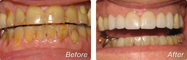 Before and after dental restoration in La Jolla by Dr. Charles Briscoe