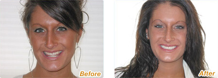Before and after photos of Six Month Smiles with Dr. Briscoe in La Jolla