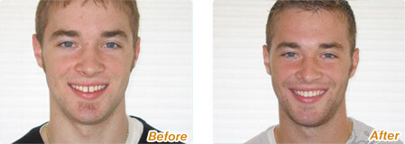 Before and after photos of Six Month Smiles results in La Jolla with Dr. Briscoe