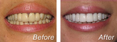 Before and after cosmetic dentistry results - Emi Hayazaki