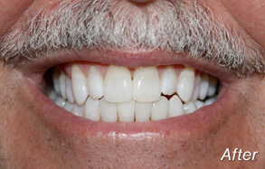 Before and after teeth whitening in La Jolla with Dr. Briscoe