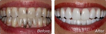 Before and after teeth whitening in San Diego with Dr. Briscoe