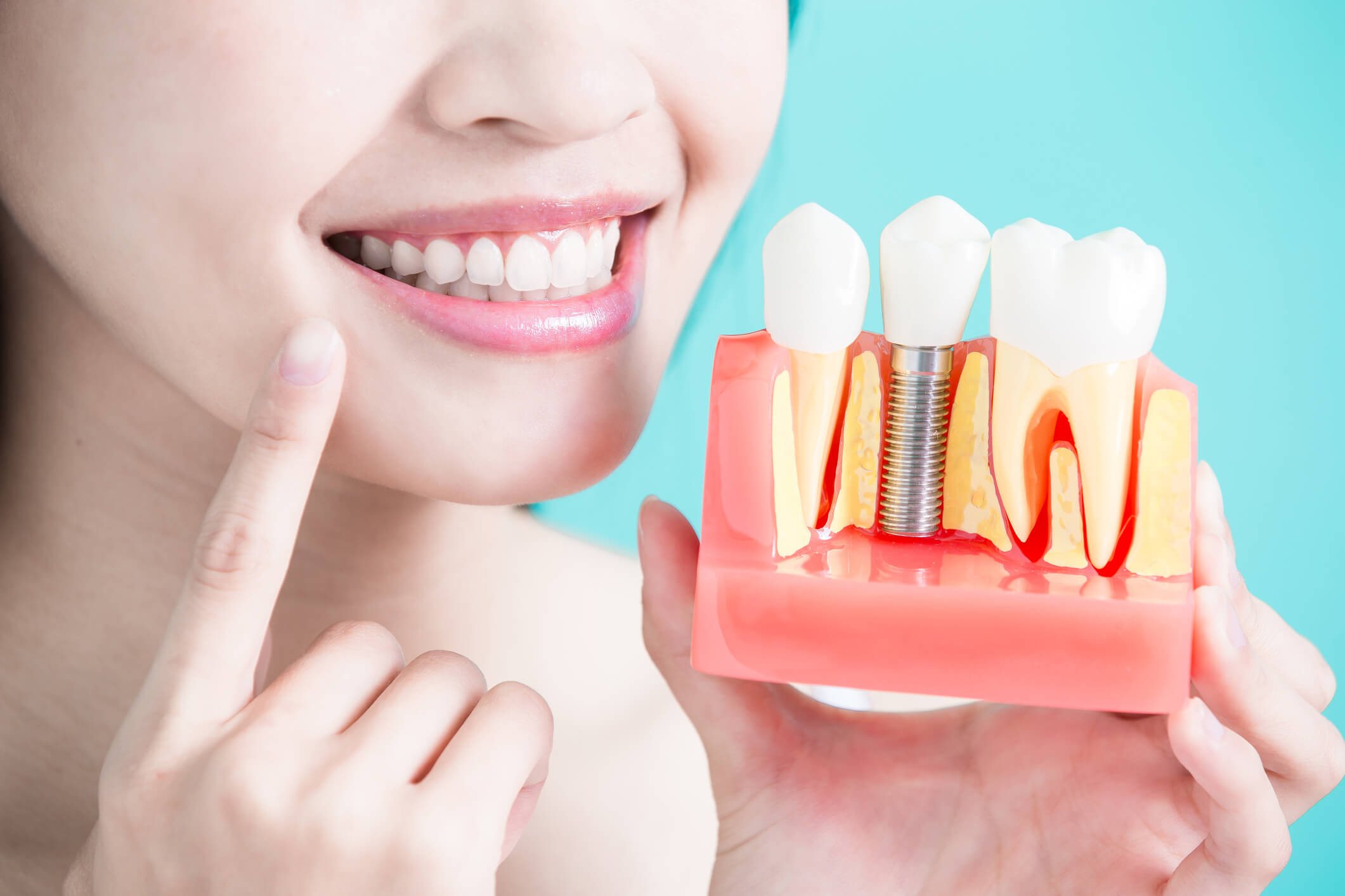 Woman smiling and pointing at teeth while holding dental implant molding