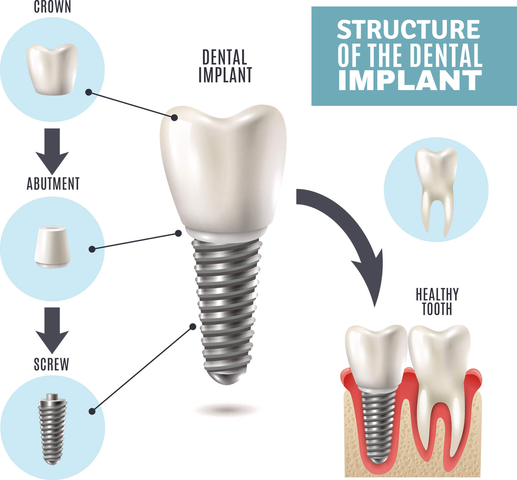 Diagram of how dental implants work
