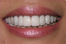 Close up photo of white teeth, smiling