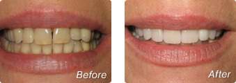 CEREC before and after results