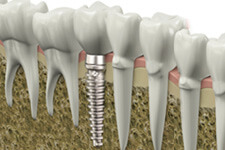 Computer generated image of dental implants