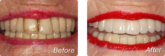 San Diego Dental Implant Results with Dr. Briscoe