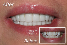 Before and after instant orthodontics with Dr. Briscoe in La Jolla