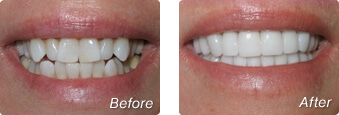 Before and after instant orthodontics with Dr. Briscoe in La Jolla