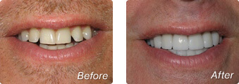 Before and after instant orthodontics with Dr. Han in La Jolla