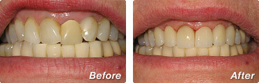 Pilar Jensen before & after photos of porcelain veneers on teeth