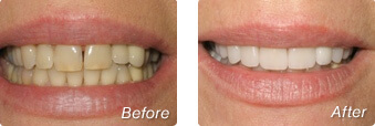 Before and after veneers with Dr. Charles Briscoe