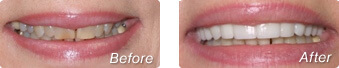 Before and after photos of porcelain veneers in La Jolla by Dr. Han